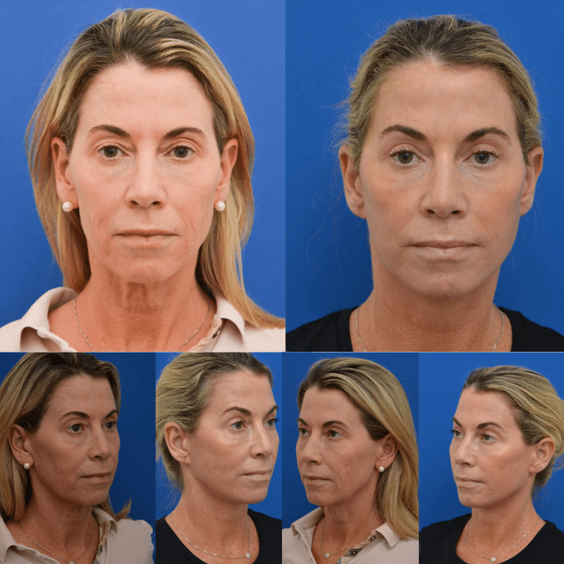 Face Glow 2.0® - Definição e Rejuvenescimento + Brinde - Imagem 2